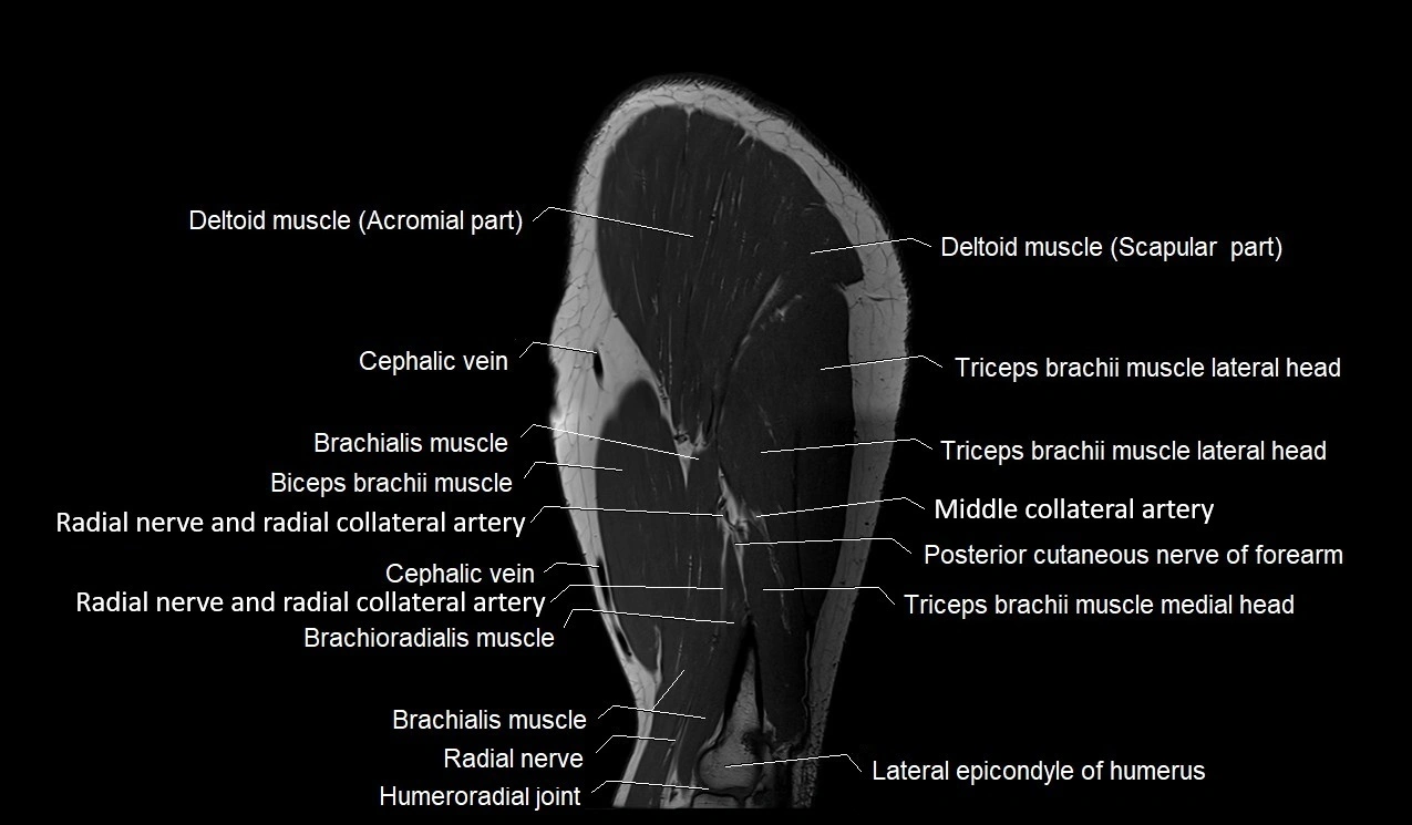 Upper arm (humerus ) saittal cross sectional anatomy 3T image 10.webp